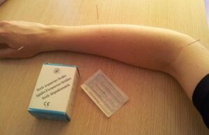 West Palm Beach Acupuncture Treatments 