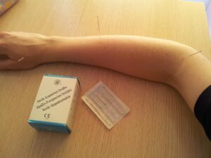 Chiropractor West Palm Beach: Relief From Shoulder And Thumb Pain With Acupuncture
