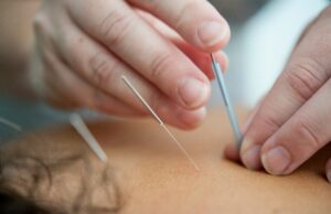 West Palm Beach Acupuncture Treatments 