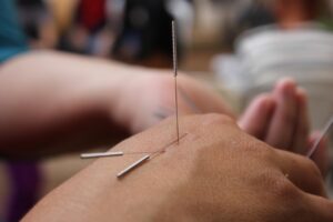 Chiropractor West Palm Beach: Acupuncture Helps Inflammation