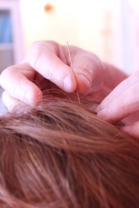 Chiropractor West Palm Beach: Acupuncture Can Help Mental Health